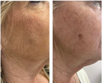 Cheek Filler - Precision Aesthetics | Ohio Valley Med Spa